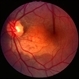 Choroidal osteoma case 1 no 4